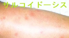 皮膚サルコイドーシス 皮膚サルコイドーシス