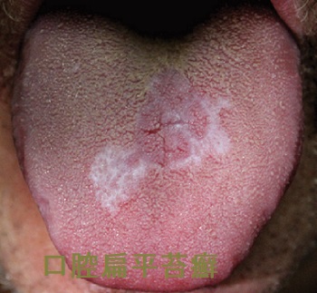 口腔扁平苔癬 舌 口腔扁平苔癬 舌