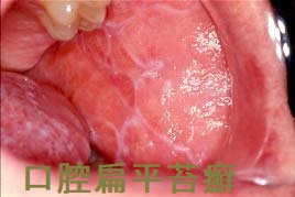 口腔扁平苔癬 頬 口腔扁平苔癬 頬