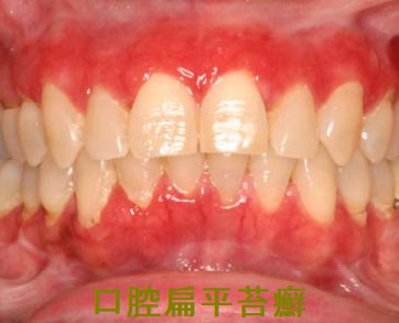 口腔扁平苔癬 歯肉 口腔扁平苔癬 歯肉