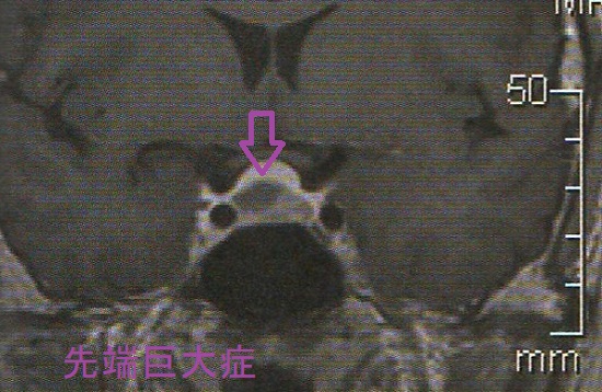 先端巨大症 造影MRI 先端巨大症 造影MRI