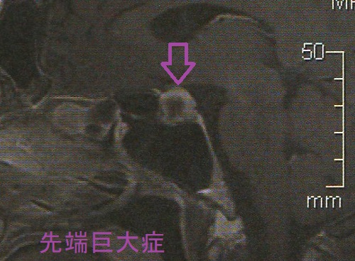 先端巨大症 造影MRI 先端巨大症 造影MRI