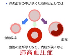 肺高血圧症 肺血管狭窄 肺高血圧症 肺血管狭窄