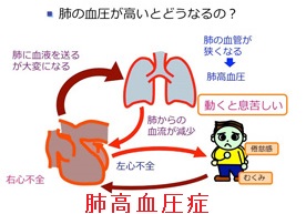 肺高血圧症と甲状腺 肺高血圧症と甲状腺
