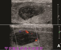 甲状腺乳頭癌充実亜型 超音波(エコー)画像 甲状腺乳頭癌充実亜型 超音波(エコー)画像