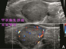 甲状腺乳頭癌充実亜型 超音波(エコー)画像 甲状腺乳頭癌充実亜型 超音波(エコー)画像