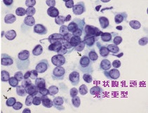 甲状腺乳頭癌充実亜型 細胞診 甲状腺乳頭癌充実亜型 細胞診