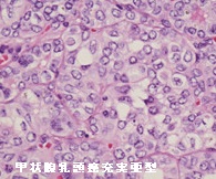 甲状腺乳頭癌充実亜型 組織診 甲状腺乳頭癌充実亜型 組織診