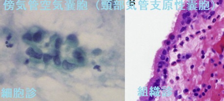 傍気管空気嚢胞(頸部気管支原性囊胞)細胞診・組織診 傍気管空気嚢胞(頸部気管支原性囊胞)細胞診、組織診