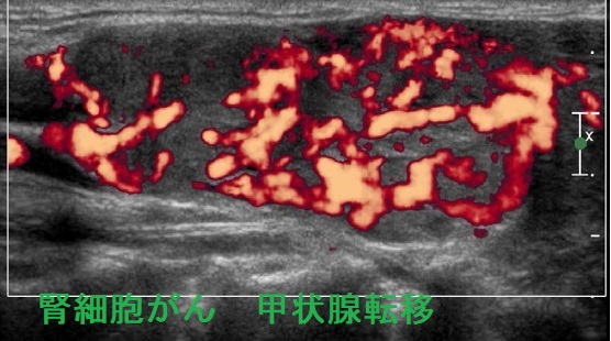 腎細胞がん 甲状腺転移 超音波(エコー)画像ドプラー 腎細胞がん 甲状腺転移 超音波(エコー)画像ドプラー