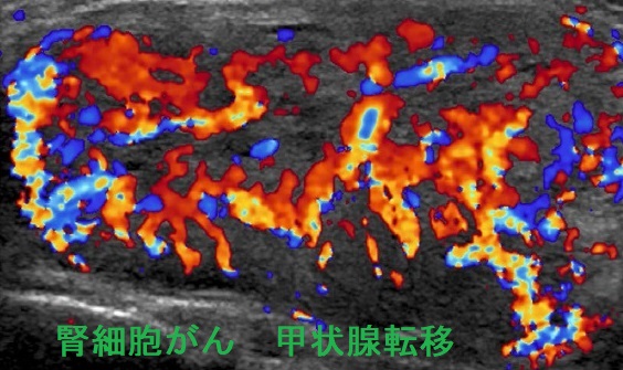 腎細胞がん 甲状腺転移 超音波(エコー)画像ドプラー 腎細胞がん 甲状腺転移 超音波(エコー)画像ドプラー