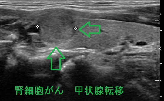腎細胞がん 甲状腺転移 超音波(エコー)画像 腎細胞がん 甲状腺転移 超音波(エコー)画像