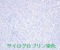 腎細胞がん 甲状腺転移 組織診 サイログロブリン染色 腎細胞がん 甲状腺転移 組織診 サイログロブリン染色
