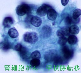 腎細胞がん 甲状腺転移 細胞診 腎細胞がん 甲状腺転移 細胞診