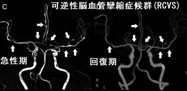 可逆性脳血管攣縮症候群(RCVS) 可逆性脳血管攣縮症候群(RCVS)
