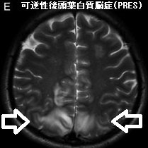 可逆性後頭葉白質脳症(PRES) 可逆性後頭葉白質脳症(PRES)