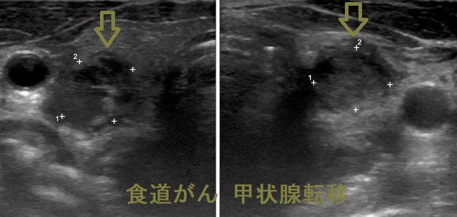 食道がん 甲状腺転移 超音波(エコー)画像 食道がん 甲状腺転移 超音波(エコー)画像