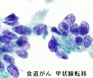 食道がん 甲状腺転移 細胞診 食道がん 甲状腺転移 細胞診