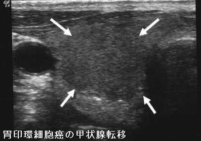 胃印環細胞癌の甲状腺転移 超音波(エコー)画像 胃印環細胞癌の甲状腺転移 超音波(エコー)画像