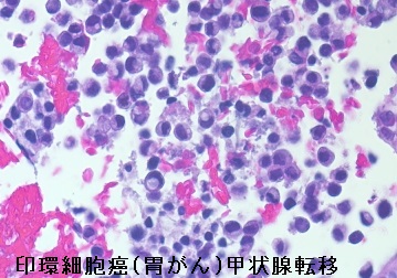 印環細胞癌(胃がん)甲状腺転移 細胞診 印環細胞癌(胃がん)甲状腺転移 細胞診