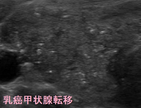 乳癌甲状腺転移 超音波(エコー)画像 乳癌甲状腺転移 超音波(エコー)画像