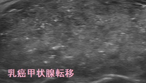 乳癌甲状腺転移 乳癌甲状腺転移 2 J Clin Ultrasound. 2014 Sep;42(7)430-2.