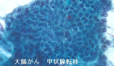 大腸がん 甲状腺転移 細胞診 大腸がん 甲状腺転移 細胞診
