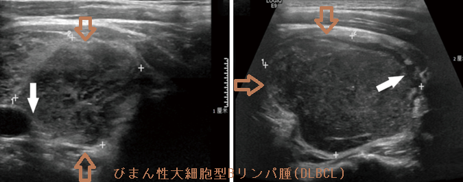 びまん性大細胞型Bリンパ腫(DLBCL)超音波(エコー)画像 びまん性大細胞型Bリンパ腫(DLBCL)超音波(エコー)画像