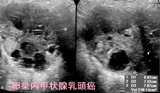 卵巣乳頭癌 超音波(エコー)画像 卵巣乳頭癌 超音波(エコー)画像