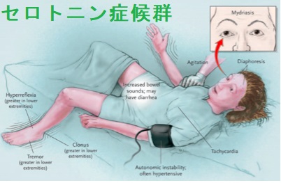 セロトニン症候群 セロトニン症候群