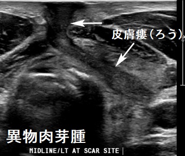 異物肉芽腫 超音波(エコー)画像 異物肉芽腫 超音波(エコー)画像