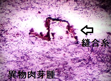 異物肉芽腫 細胞診 異物肉芽腫 細胞診