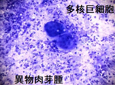 異物肉芽腫 細胞診 異物肉芽腫 細胞診