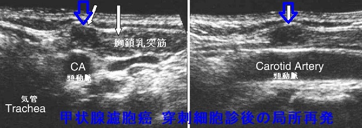 甲状腺濾胞癌 穿刺細胞診後再発 甲状腺濾胞癌 穿刺細胞診後再発