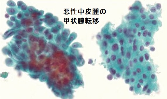 悪性中皮腫とハーテル細胞 悪性中皮腫とハーテル細胞