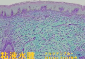 粘液水腫 アルシアンブルー(Alcian Blue)染色 粘液水腫 アルシアンブルー(Alcian Blue)染色
