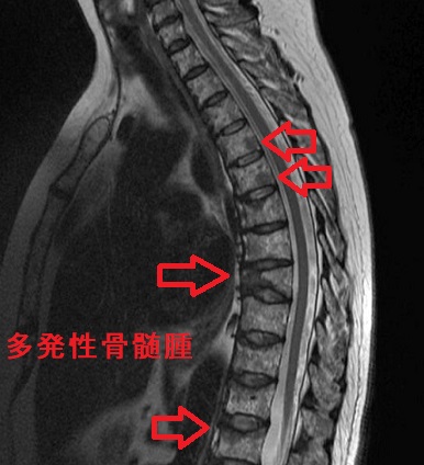 多発性骨髄腫 MRI T2画像 多発性骨髄腫 MRI T2画像