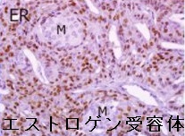モルラ型甲状腺乳頭癌 エストロゲン受容体 モルラ型甲状腺乳頭癌 エストロゲン受容体