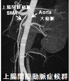 上腸間膜動脈症候群 腹部血管3D-CT 上腸間膜動脈症候群 腹部血管3D-CT