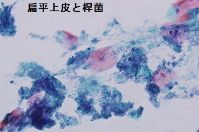 食道憩室 細胞診 扁平上皮と細菌(桿菌) 食道憩室 細胞診 扁平上皮と細菌(桿菌)