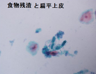 食道憩室 細胞診 扁平上皮と食物残渣 食道憩室 細胞診 扁平上皮と食物残渣