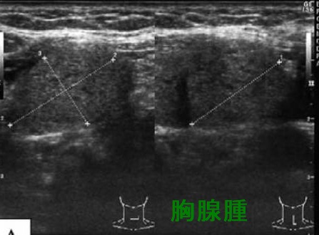 胸腺腫 超音波(エコー)画像 胸腺腫 超音波(エコー)画像