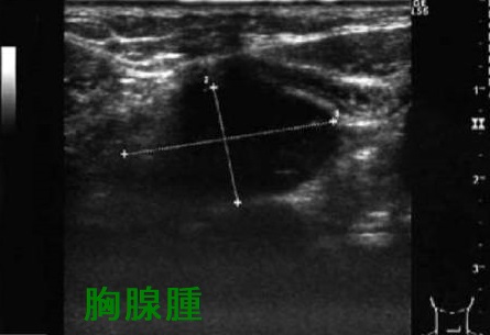 胸腺腫 超音波(エコー)画像 胸腺腫 超音波(エコー)画像