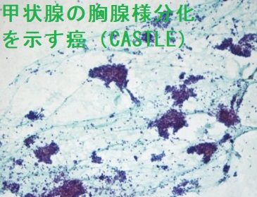 甲状腺の胸腺様分化を示す癌(CASTLE)細胞診 甲状腺の胸腺様分化を示す癌(CASTLE)細胞診