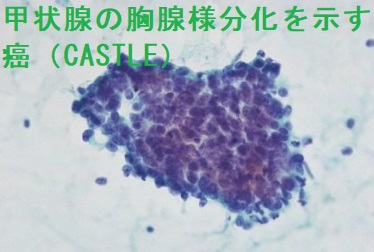 甲状腺の胸腺様分化を示す癌(CASTLE)細胞診 甲状腺の胸腺様分化を示す癌(CASTLE)細胞診