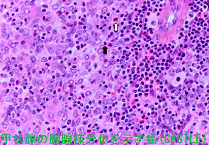 胸腺様分化を示す癌(CASTLE) 組織 胸腺様分化を示す癌(CASTLE) 組織