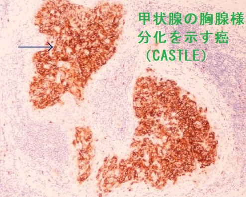 甲状腺の胸腺様分化を示す癌(CASTLE)CD5染色 甲状腺の胸腺様分化を示す癌(CASTLE)CD5染色
