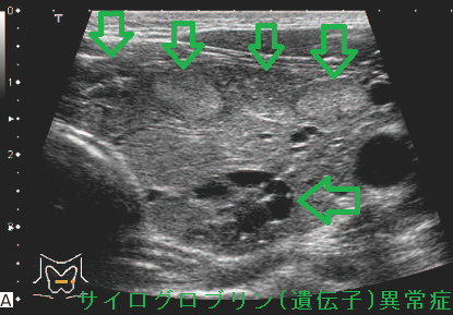 サイログロブリン異常症 超音波(エコー)画像 サイログロブリン異常症 超音波(エコー)画像