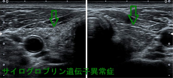 サイログロブリン異常症 超音波(エコー)画像 サイログロブリン異常症 超音波(エコー)画像