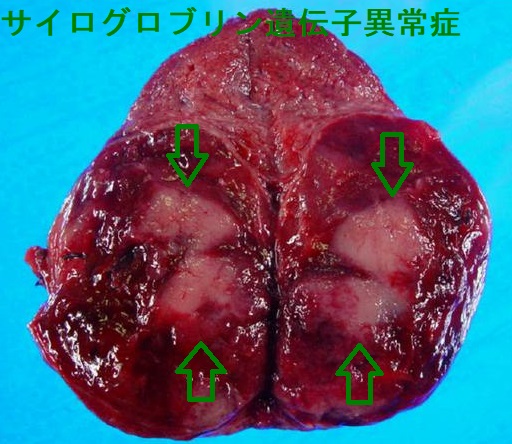 サイログロブリン異常症 手術標本 サイログロブリン異常症 手術標本